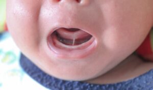 Tongue tie in baby.